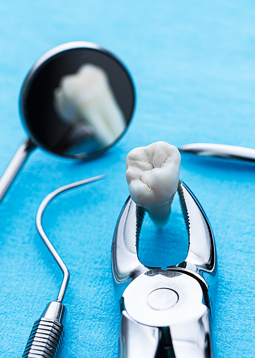 A tooth held by dental extraction forceps.